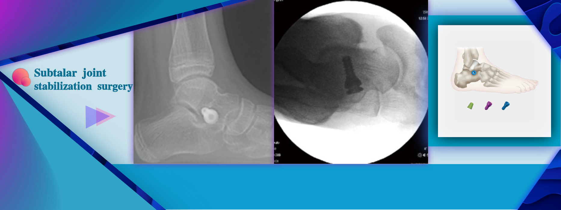 Subtalar Joint Immobilization