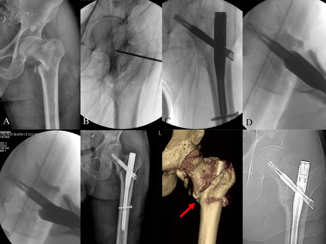 Characteristics and Surgical Techniques of Irreducible Intertrochanteric Fractures