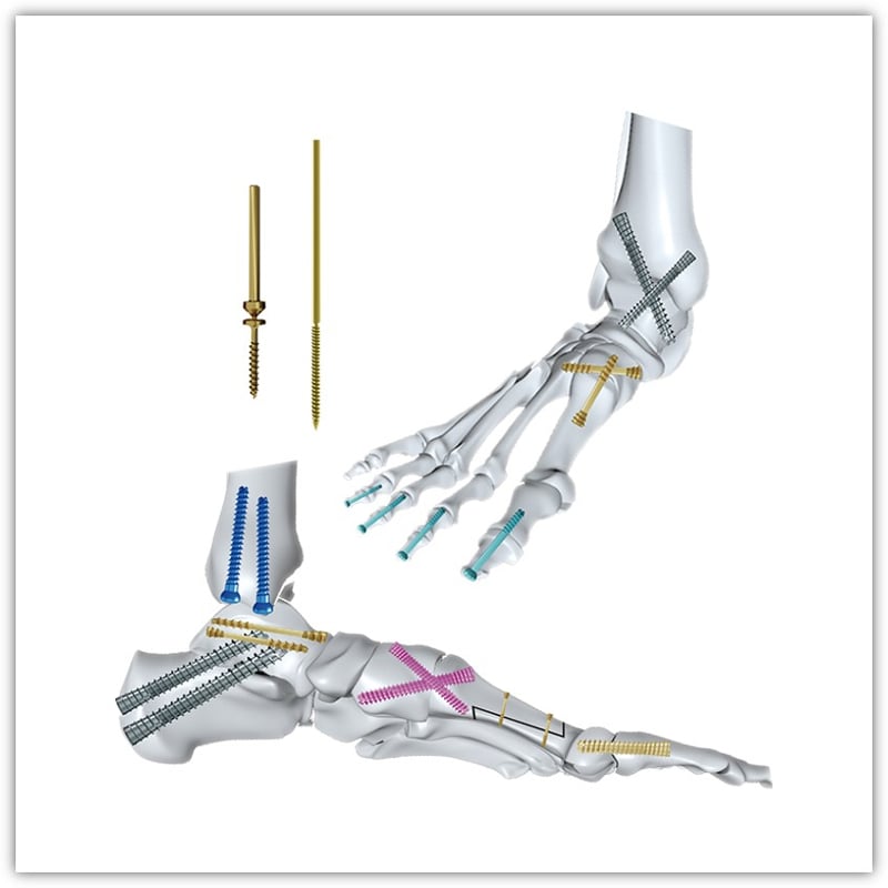 Pins & Screws — Kirschner Wire, Cannulated Screw, Cortical & Cancellous Bone Screw